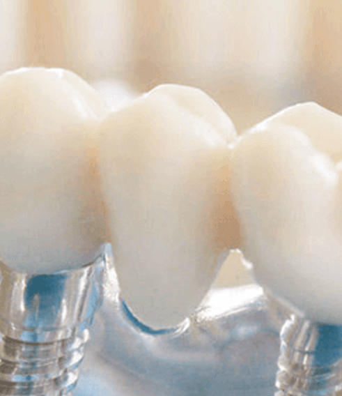 протез на имплантах фото